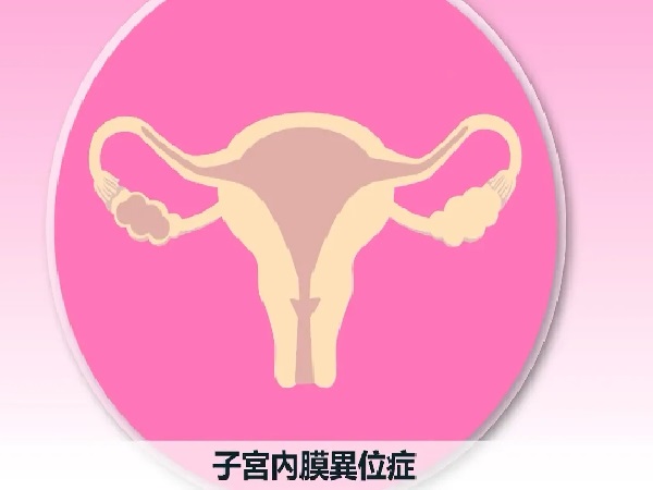 有姐妹知道女性患有子宫内膜异位症适合做第几代试管婴儿吗？