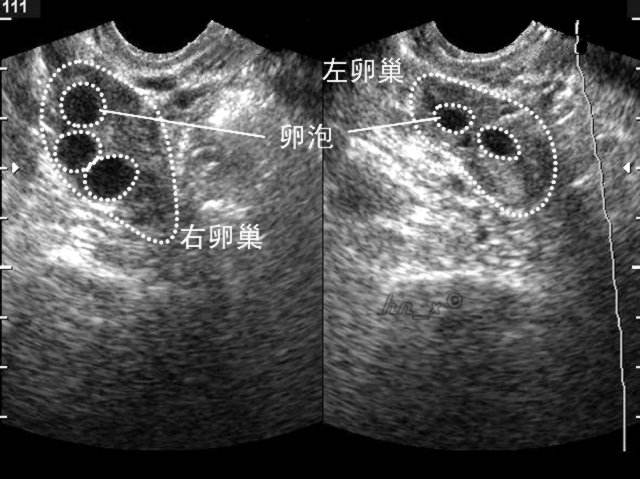 左右卵巢卵泡大小不均的ct图