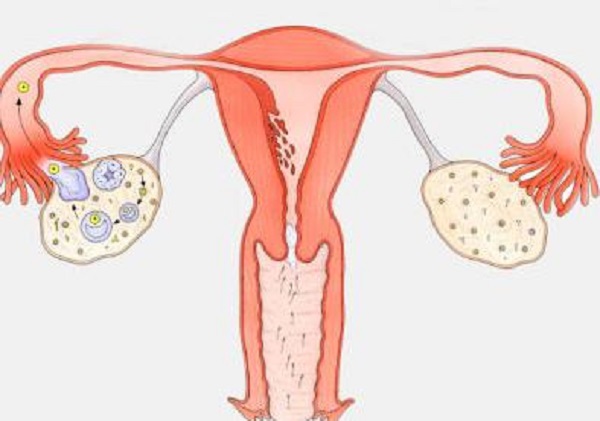 多囊卵巢综合症