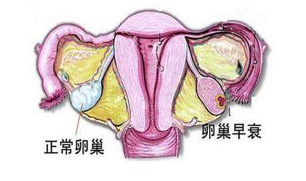 42岁卵巢早衰做试管能一次成功吗？