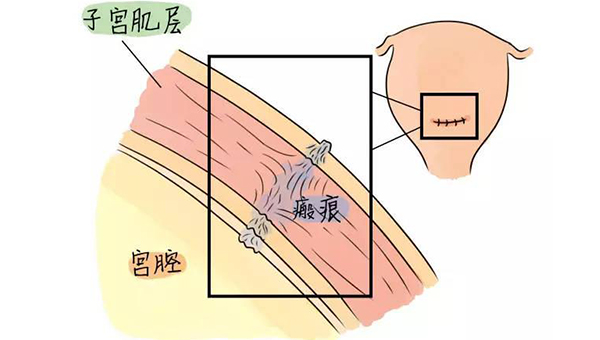 孕34周高龄产妇五年疤痕子宫2.4mm可以顺产吗-