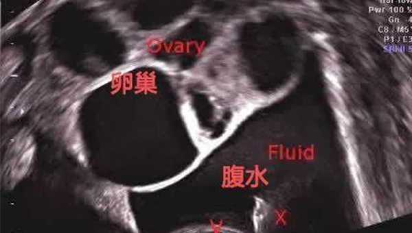 取卵后腹水有高峰期