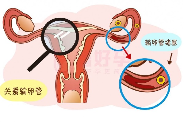 输卵管堵塞严重只能做试管