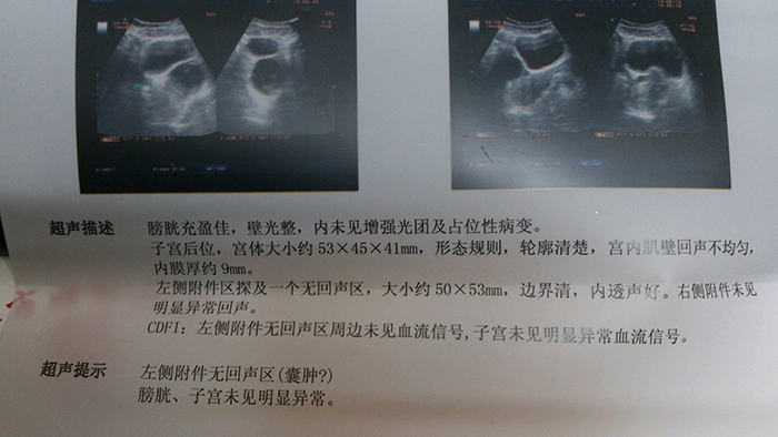 卵巢积水还能怀孕吗