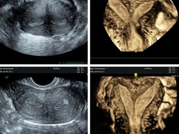 在医院做妇科彩超能查出子宫癌吗？