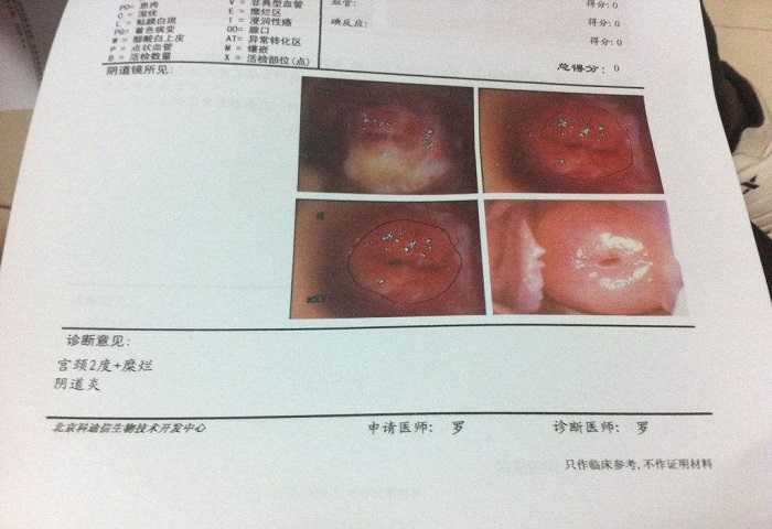 35岁，子宫糜烂二度应该怎么治疗？