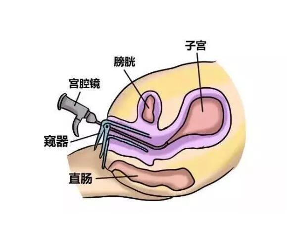 宫腔镜手术后注意事项有哪些？