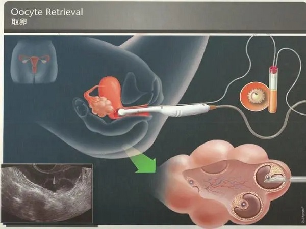 试管婴儿无痛取卵的全流程是什么？