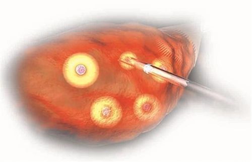 取卵的针有多粗？取卵是不是对女性伤害很大？