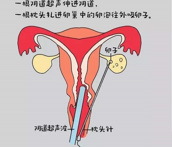 取卵时如果不打麻药会很痛吗？