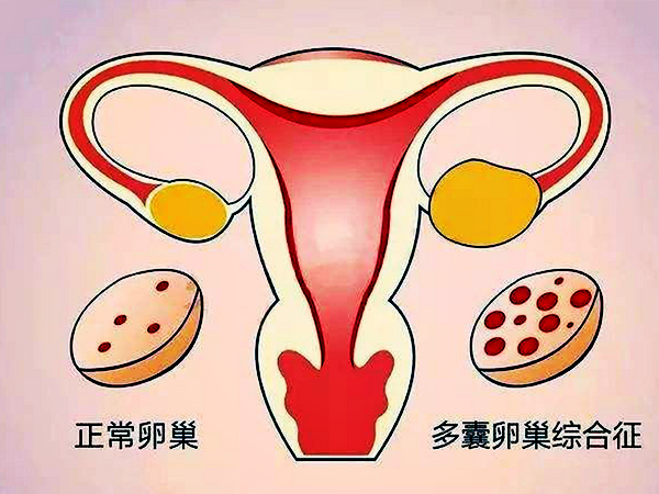 妇科彩超显示没有多囊卵巢样变就一定没有吗？