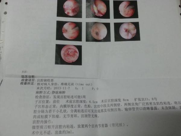 宫腔粘连检查单