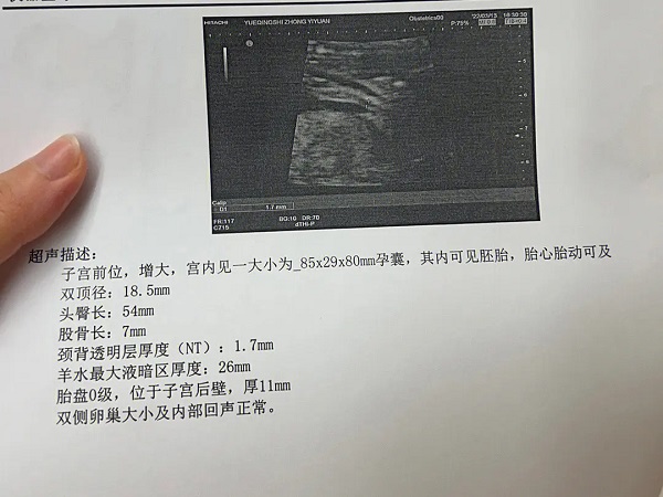 在12周的NT单子图上尾部有一个圈圈是不是标志生男孩？