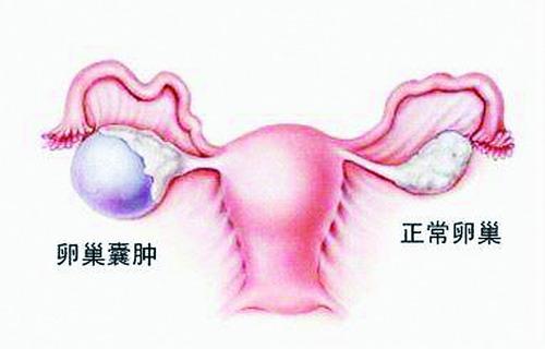 卵巢囊肿吃什么药效果好？