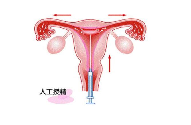 人工受孕成功率有多高？能一次就中吗？