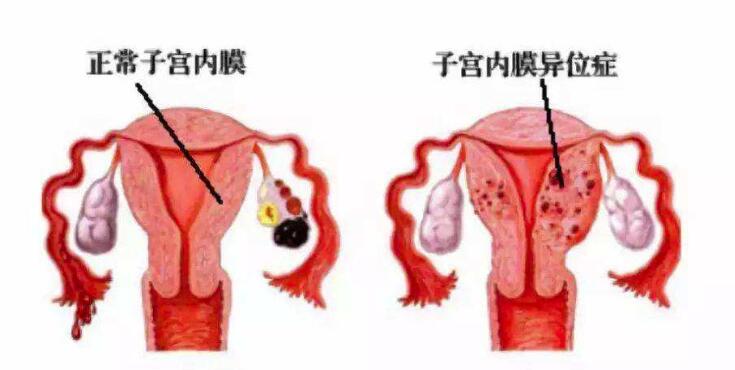 子宫内膜异位症做试管为什么用超长方案