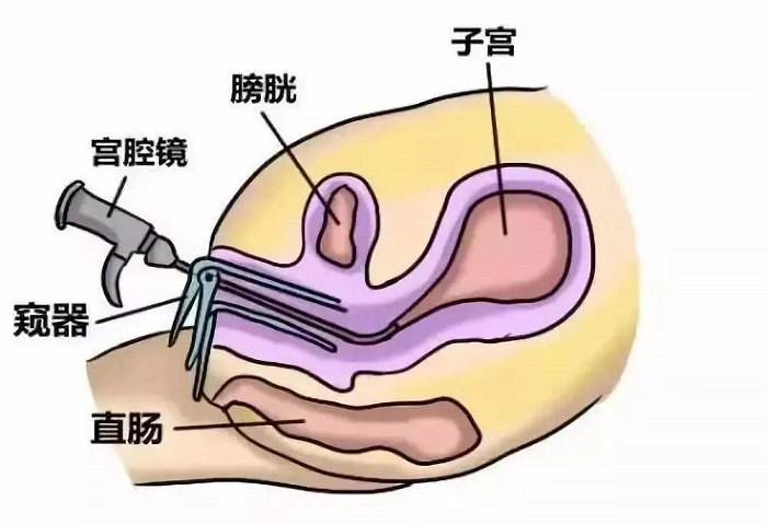 25岁月经不规律，需要做宫腔镜检查吗？宫腔镜检查疼吗？