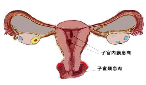 宫颈息肉怎么治疗？