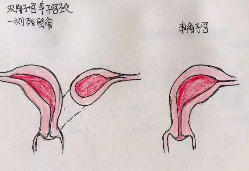 单角子宫试管成功率高吗？有一次成功的姐妹吗？