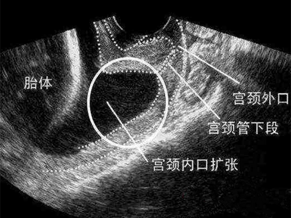 为什么32周医生就不看宫颈管了，不用考虑长度了么？