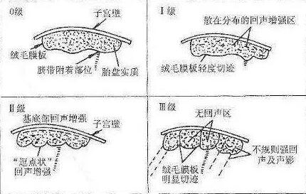 怀孕胎盘成熟度几级才会生