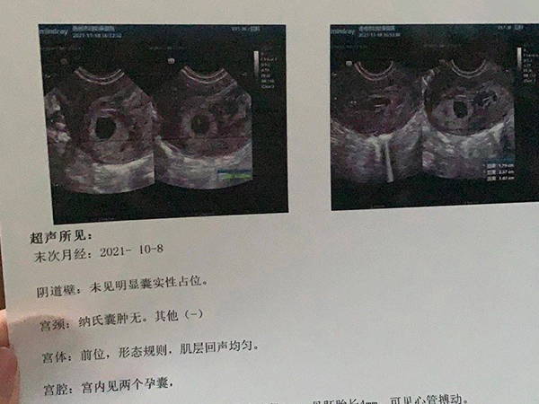 双胞胎一左一右根据孕囊三个数据怎么看男女最准？