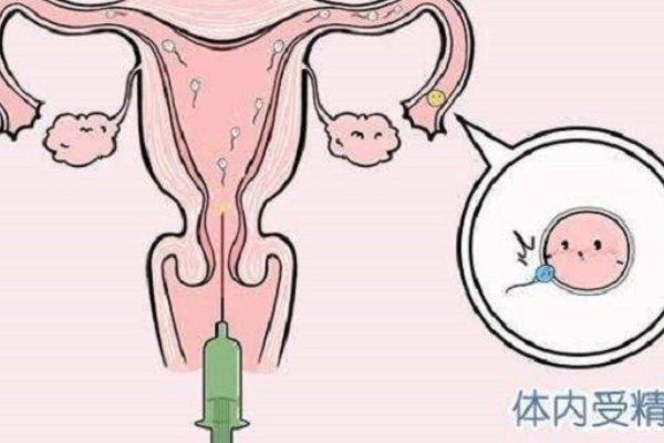 人授的助孕技术之一