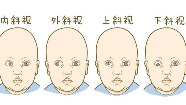 斜眼怎样改善