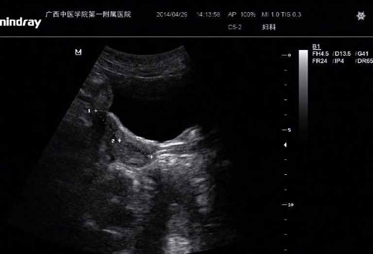 先天性幼稚子宫以后会有乳房和生育能力吗？