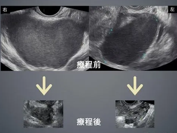 检查出巧克力囊肿大小约为3公分算严重的吗？