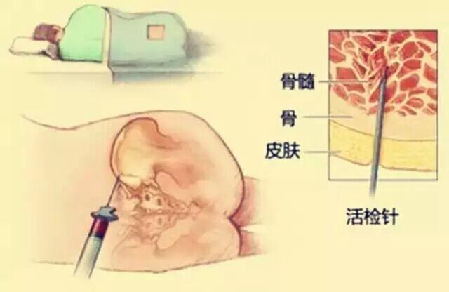 les可进行骨髓生子