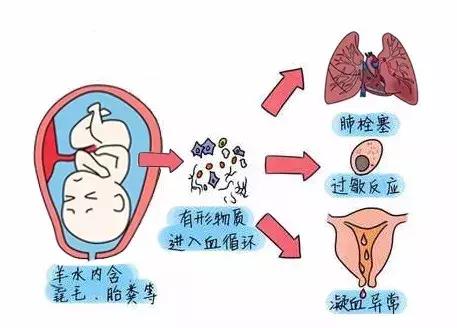 引起羊水栓塞的因素有哪些？