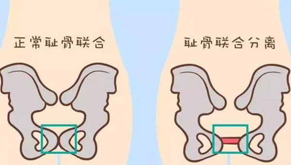 产后耻骨分离的症状