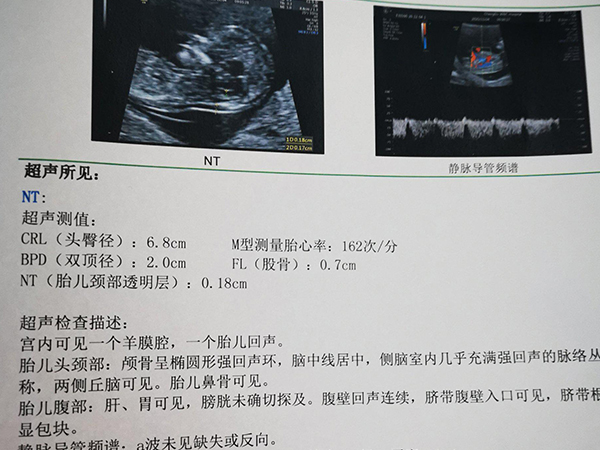 nt检查中最明显的女宝图怎么看？求详细点位图解