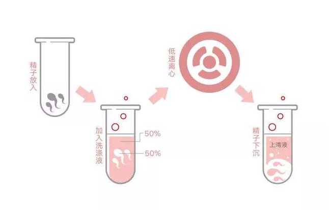 郑州精子分离术生男孩可靠吗？