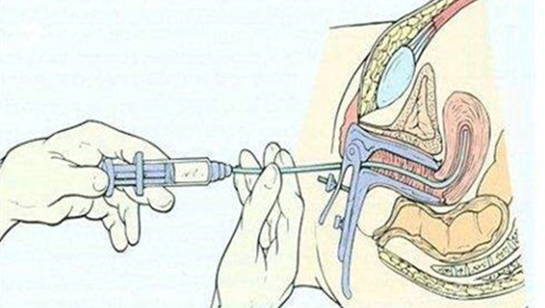 能通过人工授精来筛选基因吗？