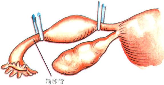 输卵管切除两边还可以怀孕吗？