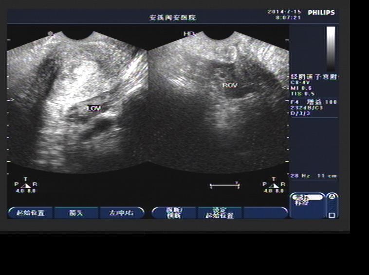 单角子宫合并残角子宫