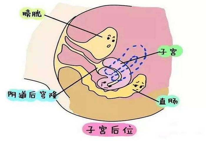 婚检时，医生说我子宫后位是什么意思-会影响受孕吗？