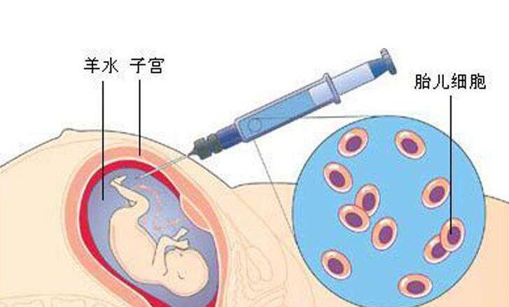 羊水穿刺的费用是多少-