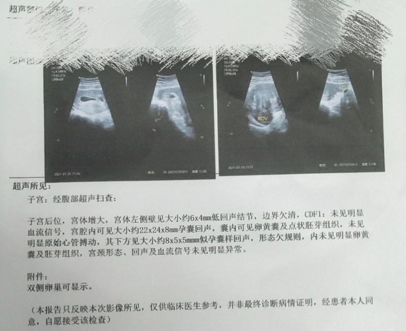 四维检查后显示双绒双羊是暗示怀龙凤胎的几率比较高吗？