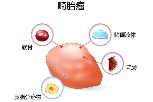 腰酸背痛，查出畸胎瘤，不手术会不会影响生育？