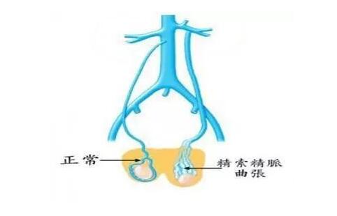 精索静脉曲张怎么治疗.jpg