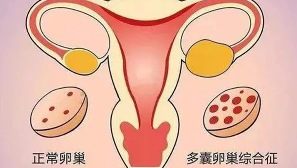 取卵后卵巢多囊病症就会消失吗？