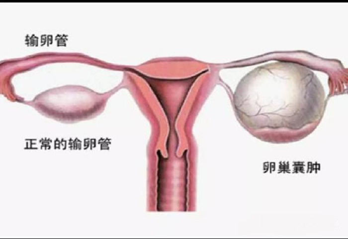 27岁未孕，孕检出一侧有卵巢囊肿怎么办？