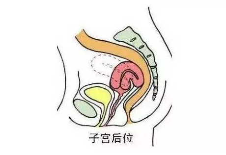 孕期检查出子宫后位，这种情况可以正常怀孕吗？