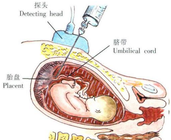 脐带血穿刺