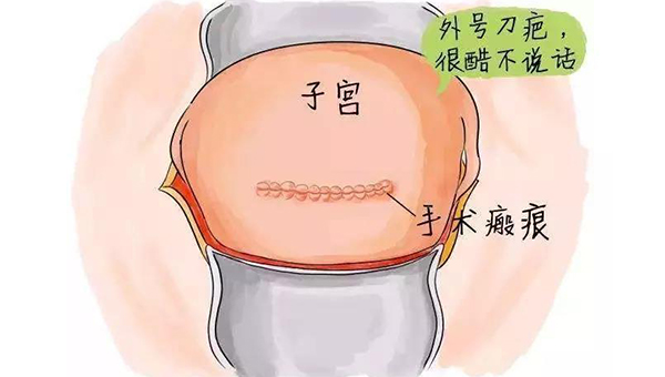 剖腹产导致疤痕子宫