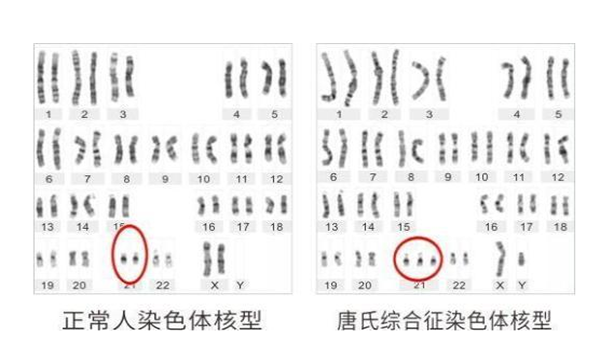 头胎畸形第二胎备孕怎么预防21三体？