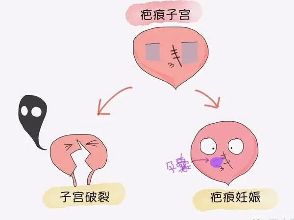 疤痕妊娠保胎困难